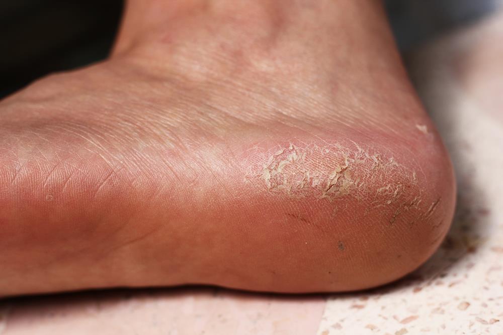 Calluses  Los Alamos, NM 